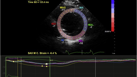 Left ventricular strain ehokardiografija-speckle tracking eho srca