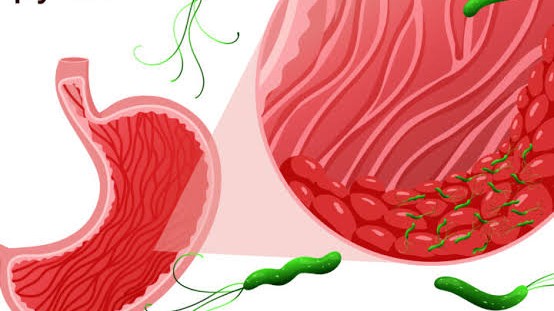 Helicobacter pylori izdisajni test-brzo, jednostavno i bez gastroskopije
